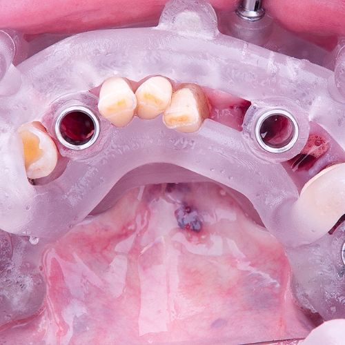 Guide chirurgical